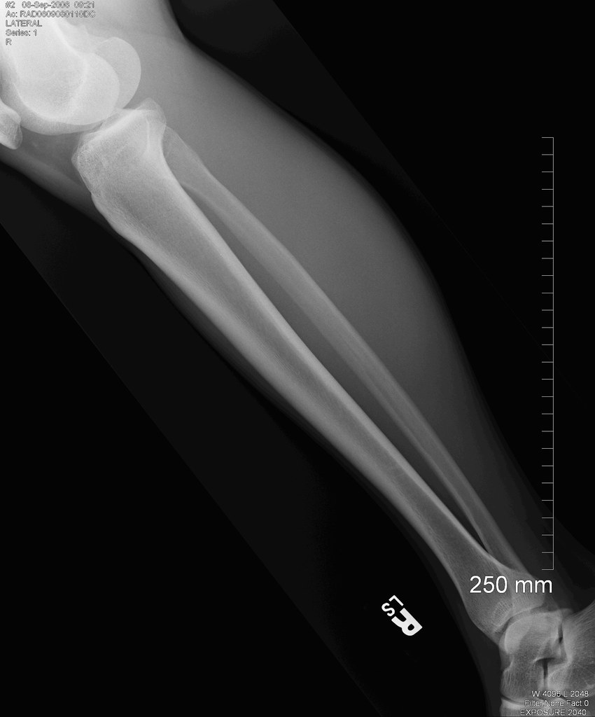 Lower Leg Tib Fib Right x-ray 0001 - no info