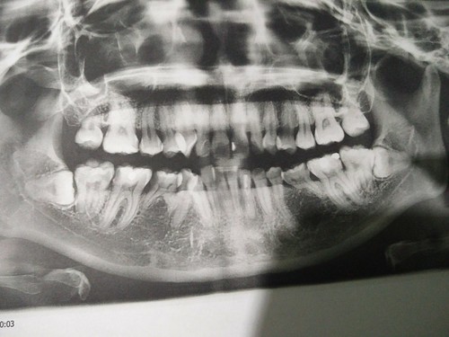 X-Ray of my teeth taken at Klinik Pergigian Dr Shal
